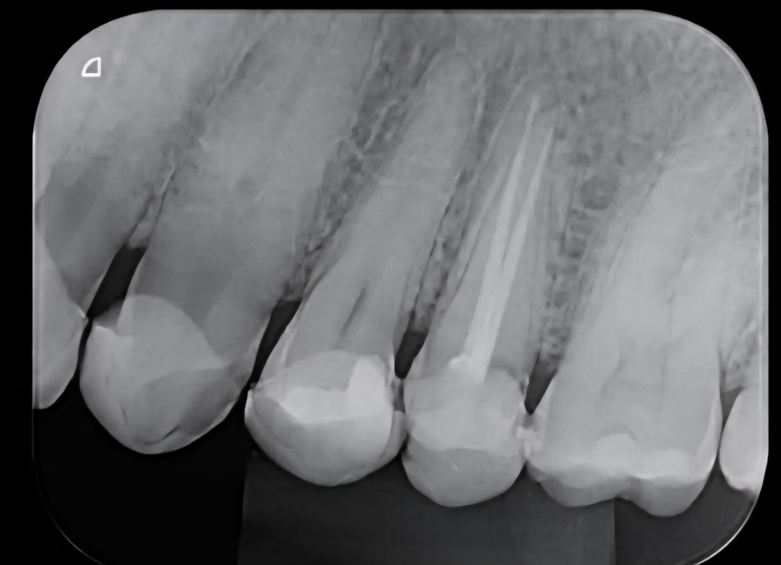 Antes e depois - Endodontia